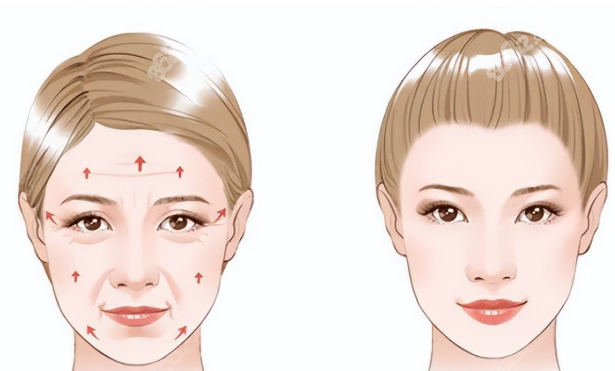 不看这篇，你的面部提升可能要多花冤枉钱